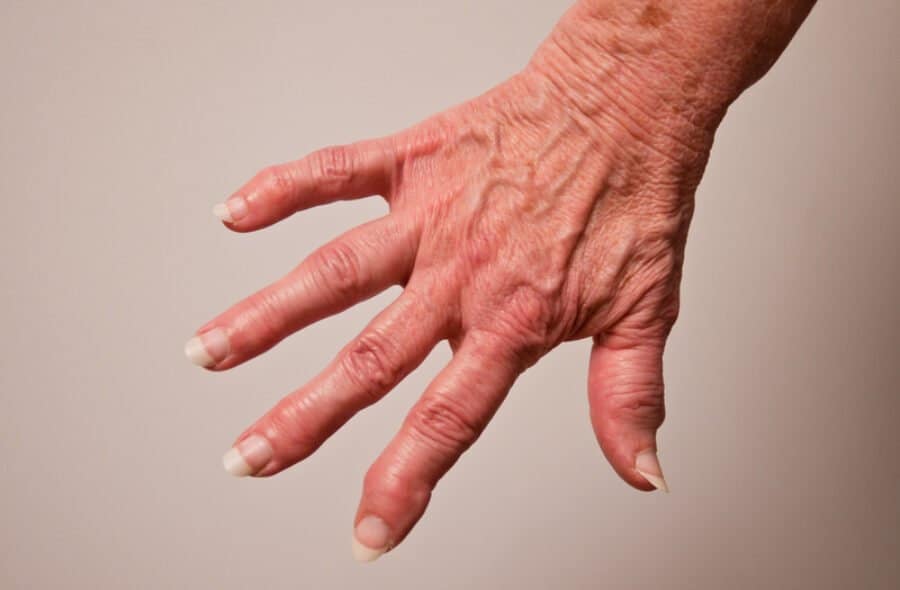Arthrose der Fingergelenke